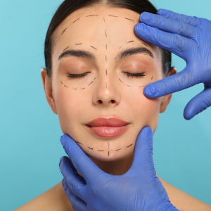 Mulher em pós-operatório com marcações faciais, representando drenagem linfática em Indaiatuba-SP